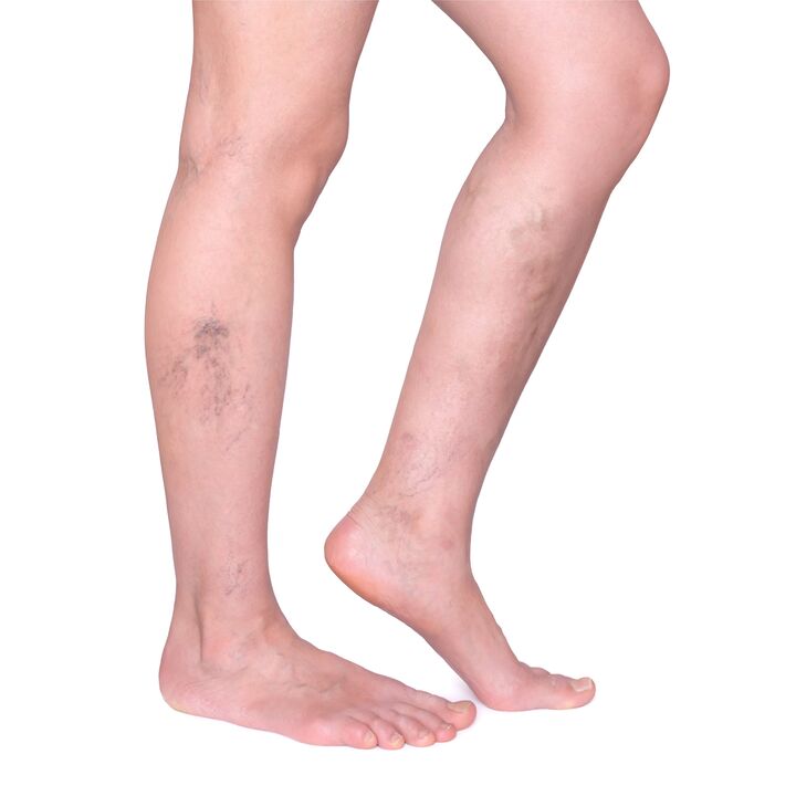 Indications for Neoveris - swollen, tortuous veins on the legs