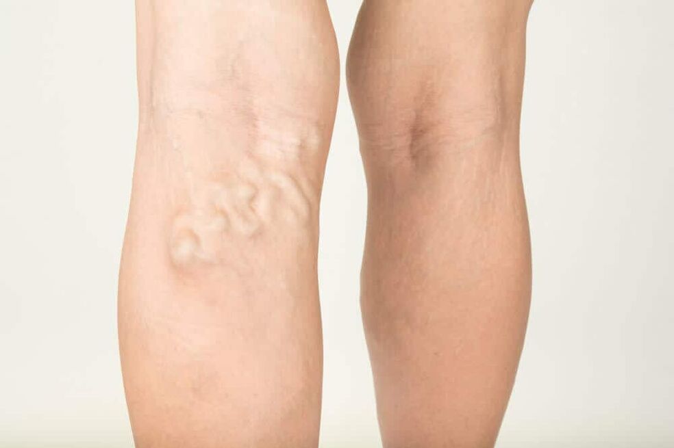 Manifestation of varicose veins