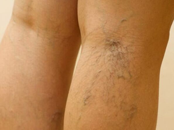 Varicose veins below the knee