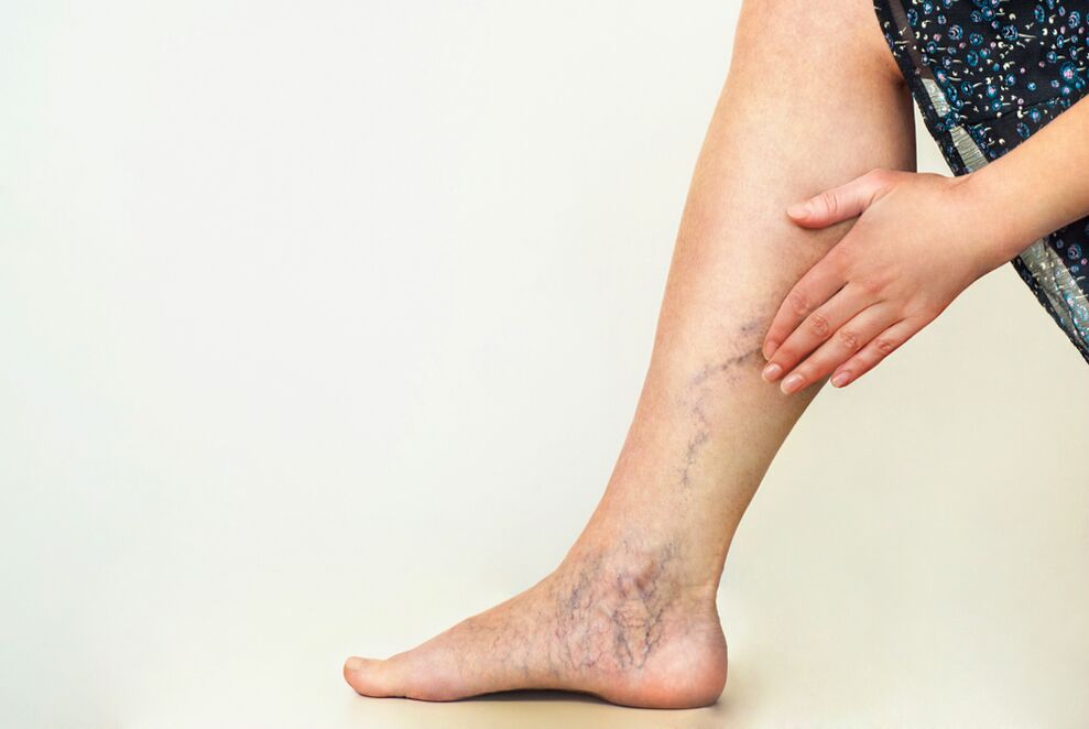 Vascular pathology in varicose veins